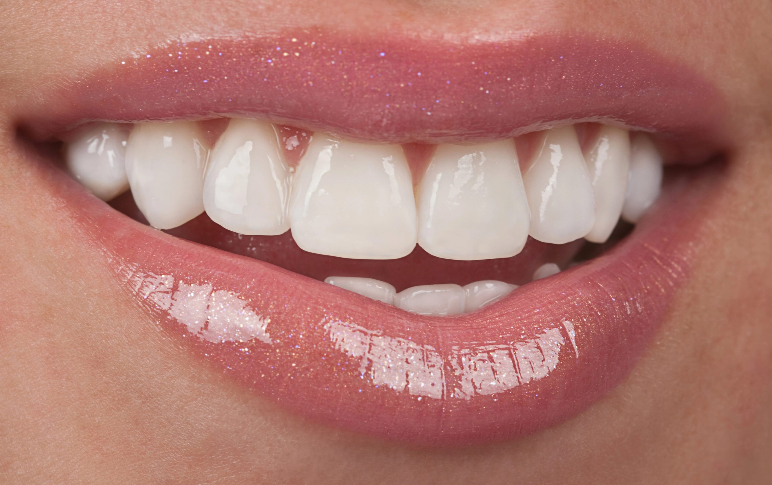 Essential Maintenance Tips for Longevity of Your Dental Veneers Norwood